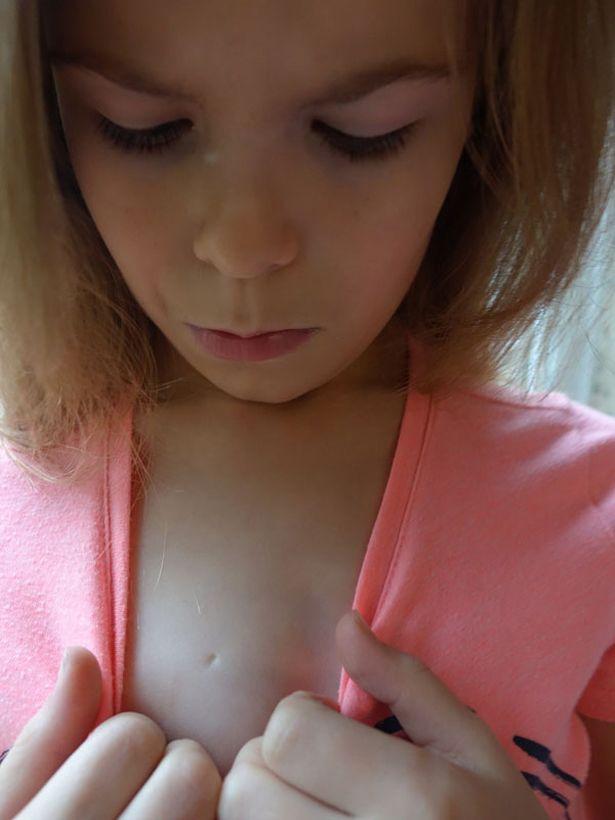 Câu chuyện cảm động phía sau vết sẹo đặc biệt trên ngực bé gái 7 tuổi-2
