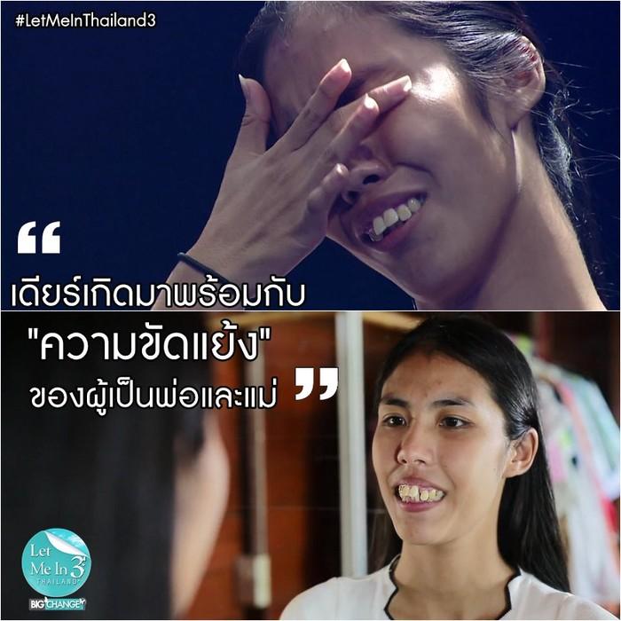 Sở hữu răng hô, chân cong cô gái này hóa mỹ nhân chỉ nhờ một cuộc phẫu thuật-3