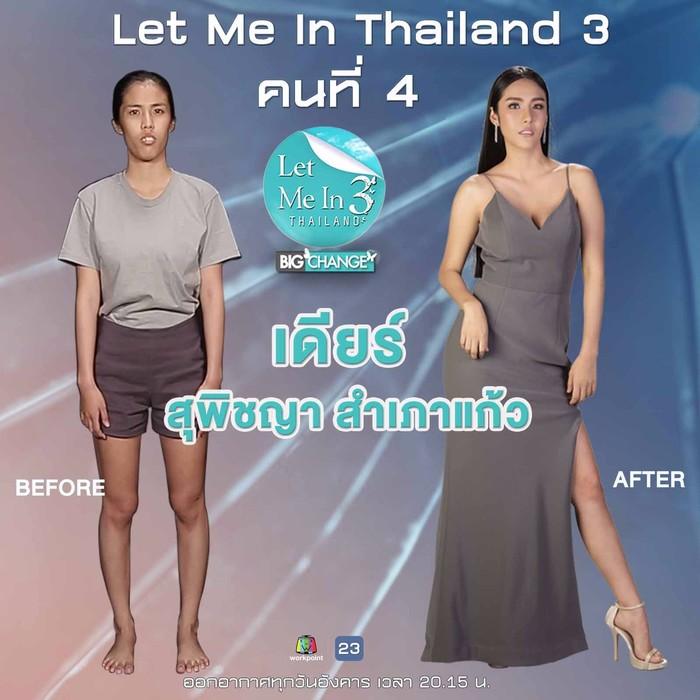 Sở hữu răng hô, chân cong cô gái này hóa mỹ nhân chỉ nhờ một cuộc phẫu thuật-1