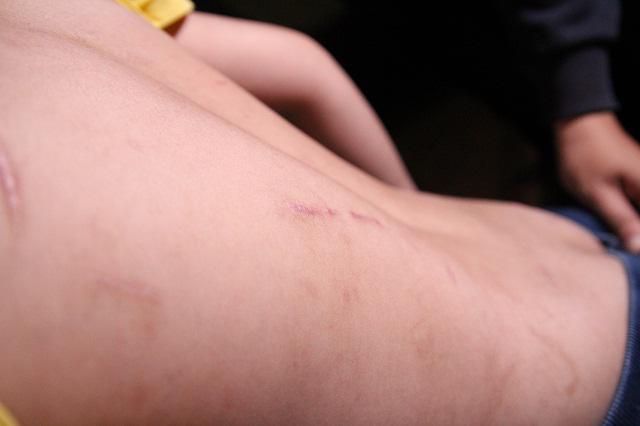 Những vết thương trên cơ thể bé trai 10 tuổi bị bạo hành ai nhìn thấy cũng xót xa-4