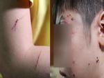 Những vết thương trên cơ thể bé trai 10 tuổi bị bạo hành ai nhìn thấy cũng xót xa