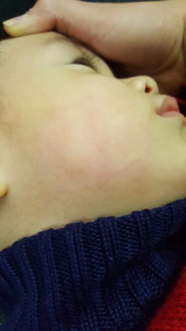 Hà Nội: Bé trai 23 tháng tuổi đi khám viêm mũi bị bác sĩ tát hằn bàn tay lên má-1