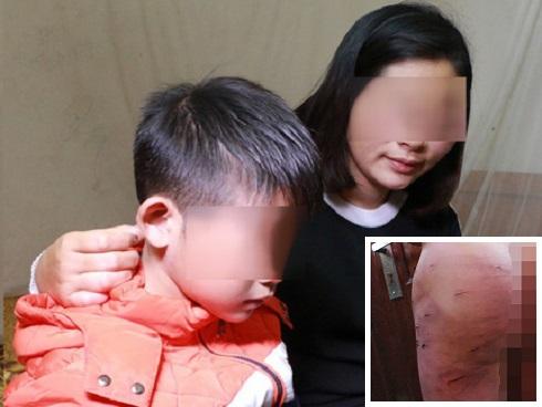 Vụ bé trai 9 tuổi bị bố đánh: Tôi chỉ đánh con vài vết lằn mông, còn lại cháu bị nhọt-5