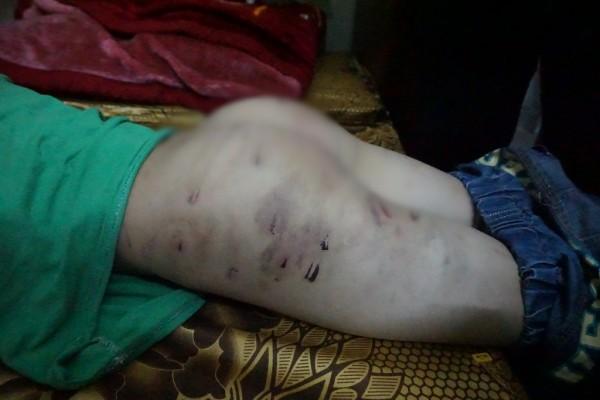 Vụ bé trai 9 tuổi bị bố đánh: Tôi chỉ đánh con vài vết lằn mông, còn lại cháu bị nhọt-2