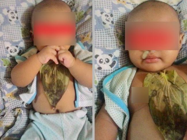 Bé gái 6 tháng tuổi bị bỏng nặng vì bà nội đắp lá trầu không chữa sổ mũi, khò khè-1