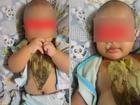 Bé gái 6 tháng tuổi bị bỏng nặng vì bà nội đắp lá trầu không chữa sổ mũi, khò khè