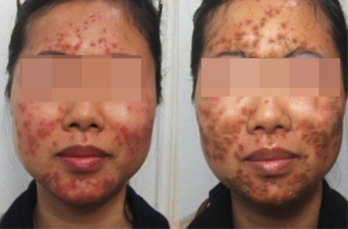 TIN PHẢI ĐỌC: Công bố danh sách những loại kem dưỡng trắng hủy hoại da không kém gì kem trộn-2