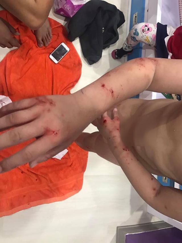 Bé trai 7 tuổi khóc thét khi kính cường lực nhà tắm bỗng dưng phát nổ-4