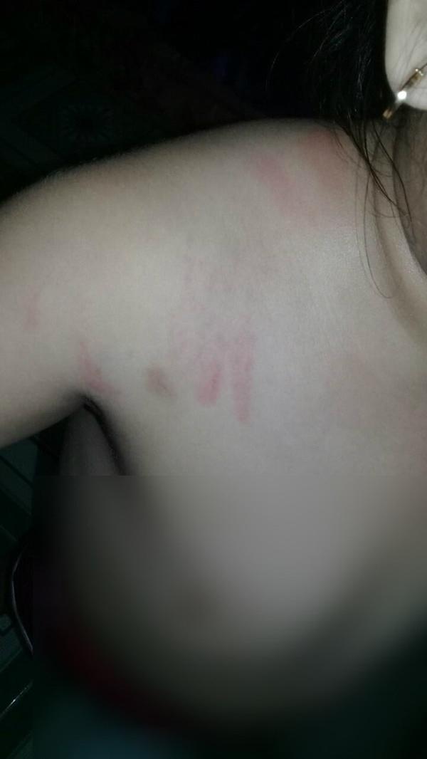 Bé gái 4 tuổi bị bạo hành ở Mầm Xanh tiếp tục có dấu hiệu bị đánh đập ở cơ sở giữ trẻ mới-3