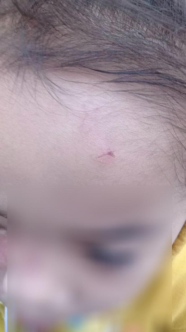 Bé gái 4 tuổi bị bạo hành ở Mầm Xanh tiếp tục có dấu hiệu bị đánh đập ở cơ sở giữ trẻ mới-4