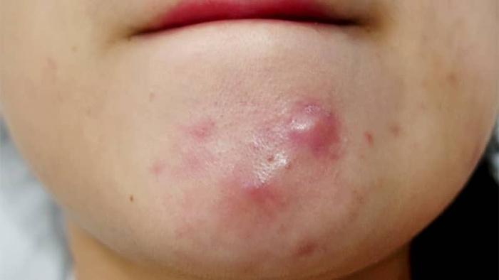 Uống thứ nước này, mụn nội tiết sạch bay chỉ sau 2 tháng, trả lại làn da láng mịn cho nàng 9X-1