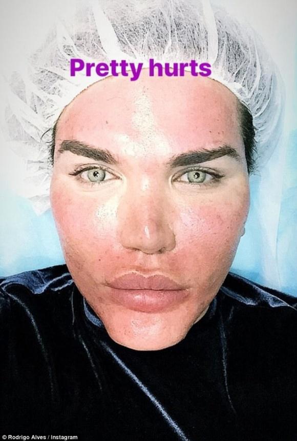 Búp bê Ken xuất hiện với gương mặt phồng rộp khiến ai nhìn cũng shock-5