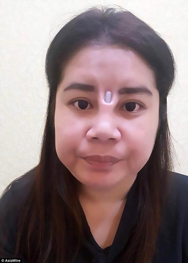 Sốc nặng hình ảnh người phụ nữ phẫu thuật hỏng, lòi cả silicon mũi ra ngoài-1