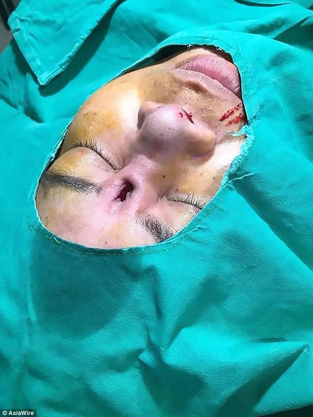 Sốc nặng hình ảnh người phụ nữ phẫu thuật hỏng, lòi cả silicon mũi ra ngoài-2