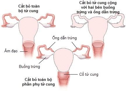 Cắt bỏ tử cung như cựu mẫu Thúy Hạnh có phải nỗi đau đớn lớn nhất của người phụ nữ?-2