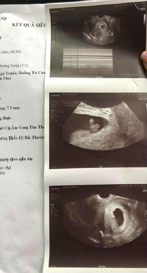 Hà Nội: Bác sĩ khẳng định thai chết lưu cho đi hút, sang viện khác khám thai vẫn bình thường-3