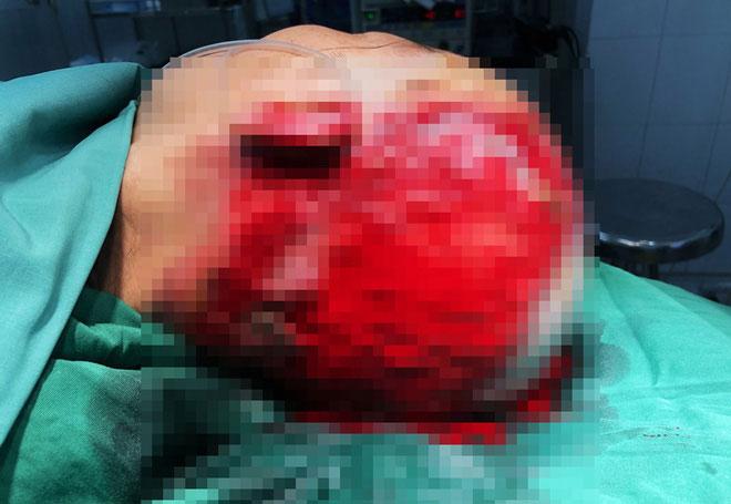 Một phụ nữ Gia Lai hoại tử da đầu, vĩnh viễn không thể mọc tóc sau khi làm đẹp kinh hoàng-1