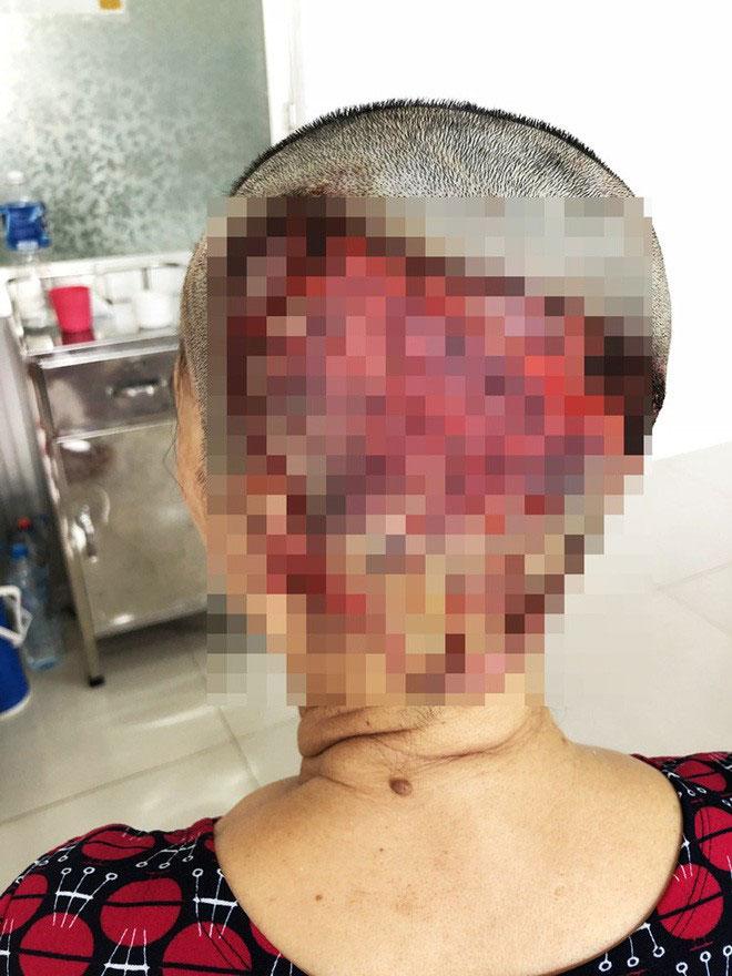 Một phụ nữ Gia Lai hoại tử da đầu, vĩnh viễn không thể mọc tóc sau khi làm đẹp kinh hoàng-2