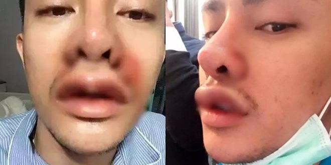 Trai quê xấu xí bỏ cả trăm triệu đồng thẩm mỹ để thành hotboy vạn người mê-2