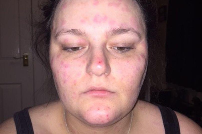 Sắp lên xe hoa, cô gái trẻ phải hoãn đám cưới vì bệnh lạ khiến mặt phồng rộp như bị bỏng-1