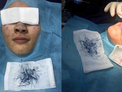 Nâng mũi xong xanh lét, bác sĩ tá hoả gắp ra cả đống chỉ