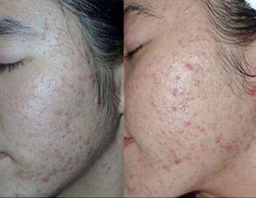 Khuôn mặt đáng sợ của cô gái khiến chị em dè chừng với mỹ phẩm không rõ nguồn gốc-4