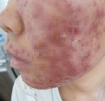 Khuôn mặt đáng sợ của cô gái khiến chị em dè chừng với mỹ phẩm không rõ nguồn gốc-7