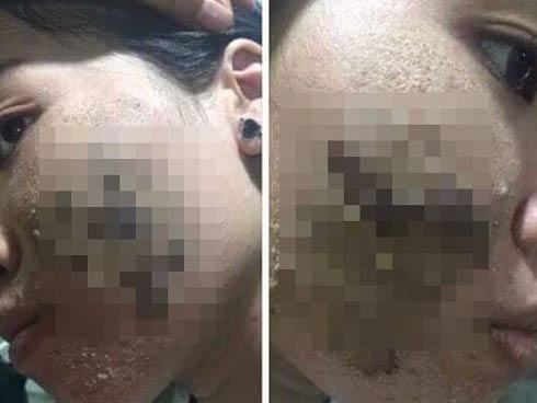 Khuôn mặt đáng sợ của cô gái khiến chị em dè chừng với mỹ phẩm không rõ nguồn gốc