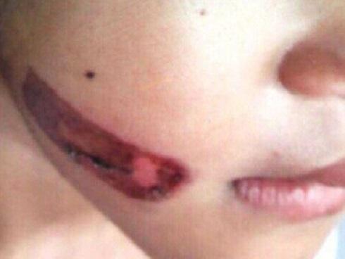 Bé gái nghi bị cha bạo hành gí thanh sắt nóng vào mặt đã bỏ học