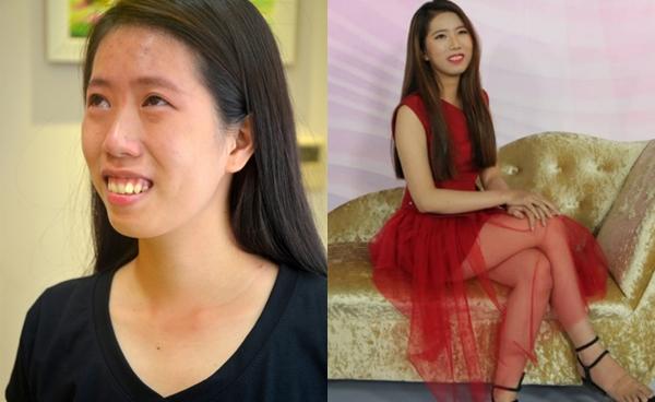 Trở về từ ca phẫu thuật hàm hô, cô gái trẻ khiến người thân không nhận ra-1