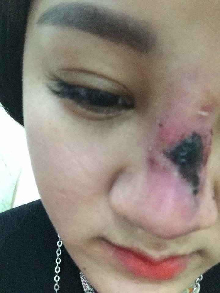 Nâng mũi của bác sĩ 17 tuổi, cô gái trẻ khóc không ra tiếng vì hoại tử đau đớn-2