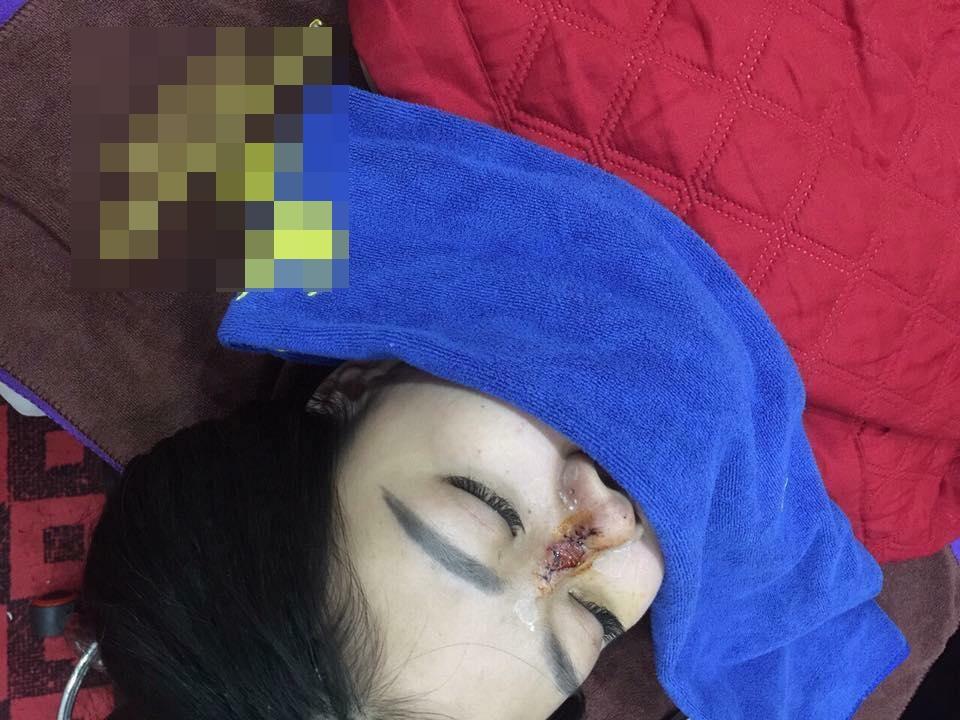 Nâng mũi của bác sĩ 17 tuổi, cô gái trẻ khóc không ra tiếng vì hoại tử đau đớn-4