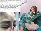 Nâng mũi của 'bác sĩ' 17 tuổi, cô gái trẻ 'khóc không ra tiếng' vì hoại tử đau đớn