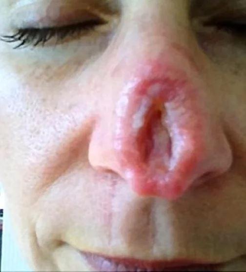 KHIẾP SỢ: Mũi thủng lỗ khổng lồ chỉ vì dùng thuốc mỡ sai cách-3