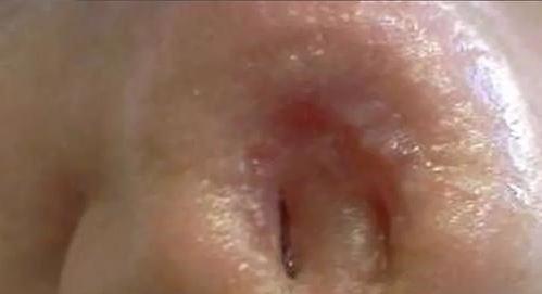 KHIẾP SỢ: Mũi thủng lỗ khổng lồ chỉ vì dùng thuốc mỡ sai cách-4