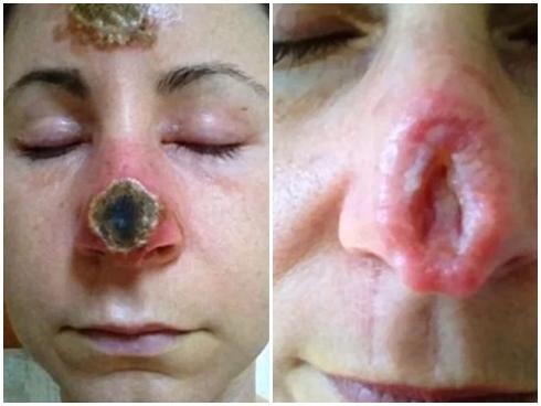 KHIẾP SỢ: Mũi thủng lỗ khổng lồ chỉ vì dùng thuốc mỡ sai cách