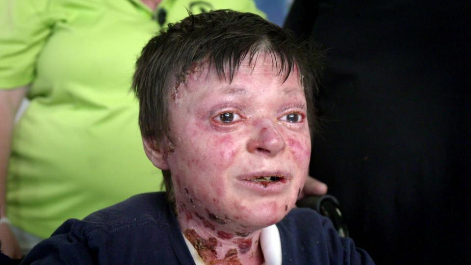 Mắc bệnh lạ bẩm sinh, thanh niên 17 tuổi sống còn đau đớn hơn chết-1