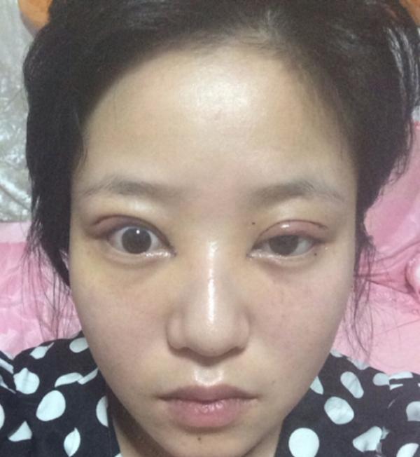 Những pha thẩm mỹ cắt mí thảm nhất 2017-6