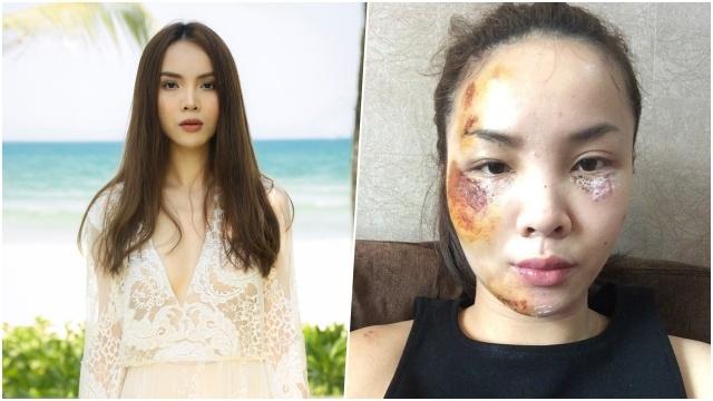 Không chỉ Harry Lu, nhiều Sao Việt cũng từng gặp tai nạn nguy hiểm đến tính mạng-7