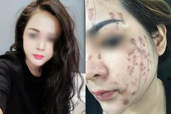 Cô gái cháy loang mặt sau khi chấm nám: Cần gặp chuyên gia da liễu sớm nếu không muốn xấu xí cả đời-2