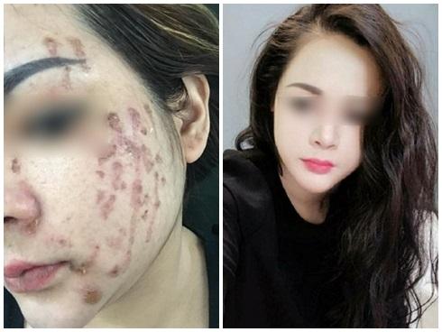 Cô gái cháy loang mặt sau khi chấm nám: Cần gặp chuyên gia da liễu sớm nếu không muốn xấu xí cả đời