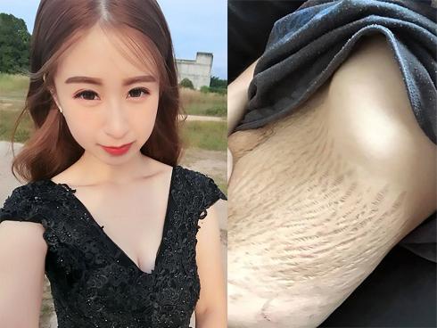 Cô gái xinh đẹp khiến nhiều chị em đồng cảm khi khoe da bụng rạn tung tóe sau lần sinh 4