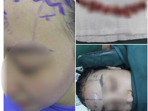 Hình ảnh kinh hoàng của cô gái cắt da đầu, sửa trán bớt cao khiến chị em phải suy nghĩ trước khi 'dao kéo'