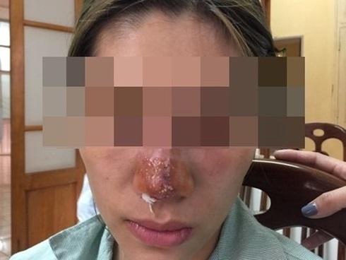 Cảnh báo: Đừng lạm dụng tiêm filler có ngày hoại tử mất mặt, mất người không biết kêu ai