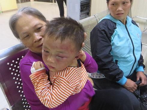 Bé trai 2 tuổi nghi bị bạo hành phải nhập viện