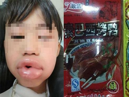 Bé 6 tuổi môi sưng phồng, phải nhập viện cấp cứu sau 3 phút ăn kẹo mua ở cổng trường