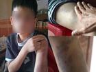 Hà Nội: Bé trai 14 tuổi bị bố cùng mẹ kế đánh bầm dập cơ thể, tụ máu trong mắt