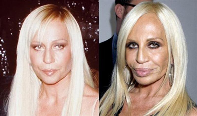Donatella Versace cũng bị cho là thảm họa phẫu thuật thẩm mỹ.