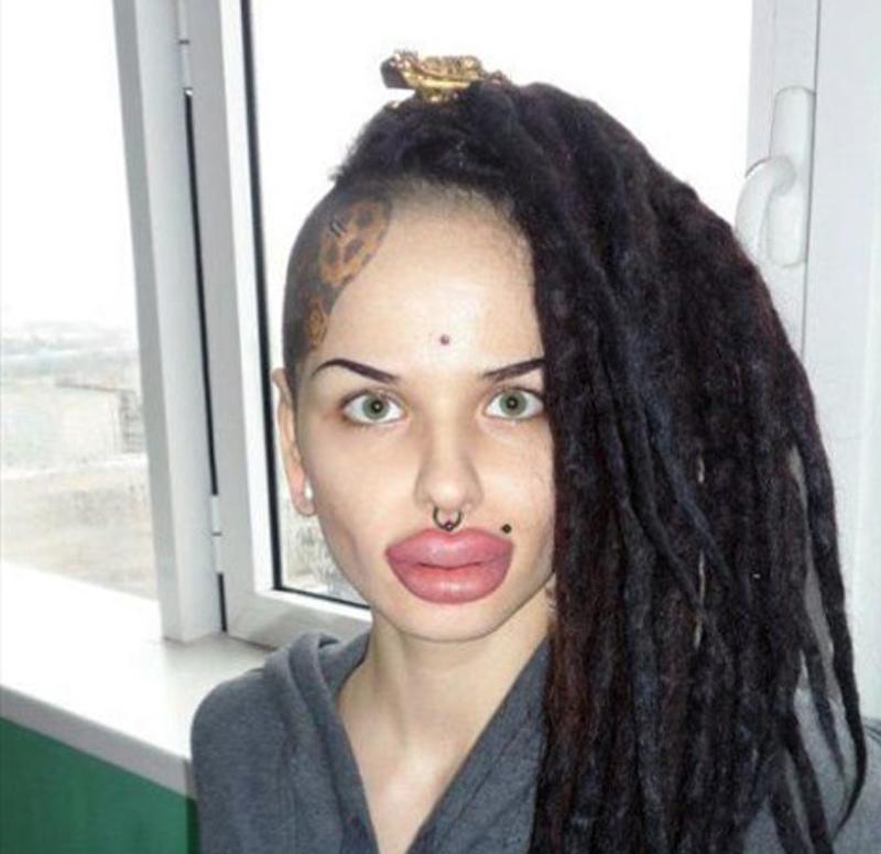 Bơm môi quá đà, sai cách quả thật sẽ để lại hậu quả khó lường.