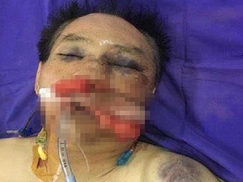 Bé 14 tháng tuổi vỡ tim, dập phổi do người thân đạp nhầm chân ga-2